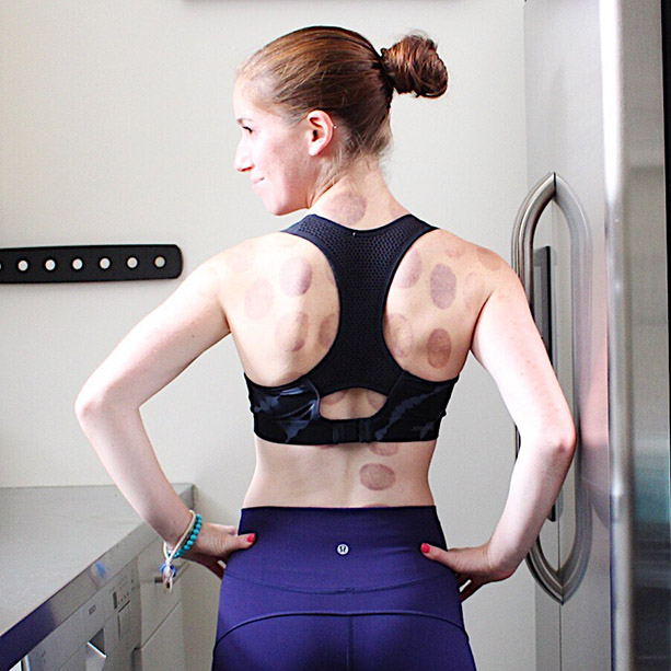 cupping therapy, first time cupping therapy, what you need to know about cupping