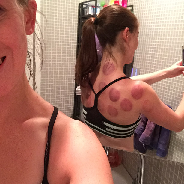 cupping therapy, first time cupping therapy, what you need to know about cupping