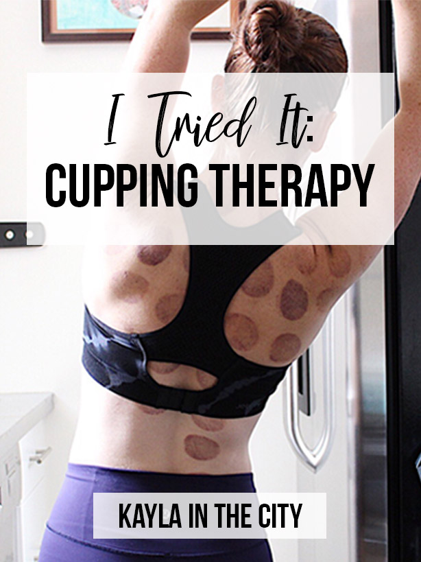 cupping therapy, cupping, benefits of cupping therapy, alternative medicine, chinese medicine